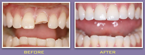 Dental Crown - Melissa, TX Dentist
