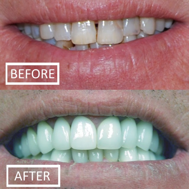 smile makeover dentist melissa tx incl westminster, anna, mckinney, tx