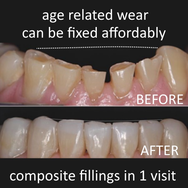 Melissa Dentist - Bonding worn teeth After | Paradise Dental