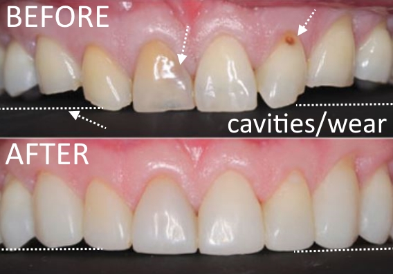 before after smile makeover dentist in Melissa Mckinney TX 