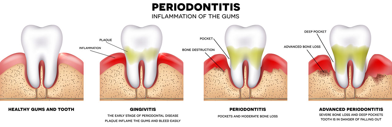 Stages of Periodontal Disease - Dentist Melissa, TX | Paradise Dental
