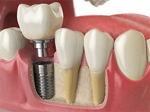 Melissa, TX Dentist - Tooth Implants