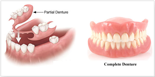 Dentures - Melissa, TX - Paradise Dental