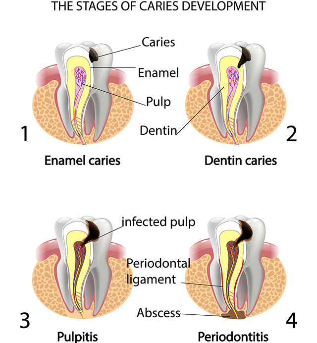 Stages of Cavity Development - Melissa, TX Dentist