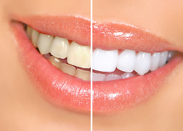 Teeth Whitening Dentist Near Me | Paradise Dental