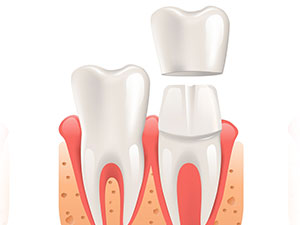 Dentist in Melissa, TX - Dental Crowns