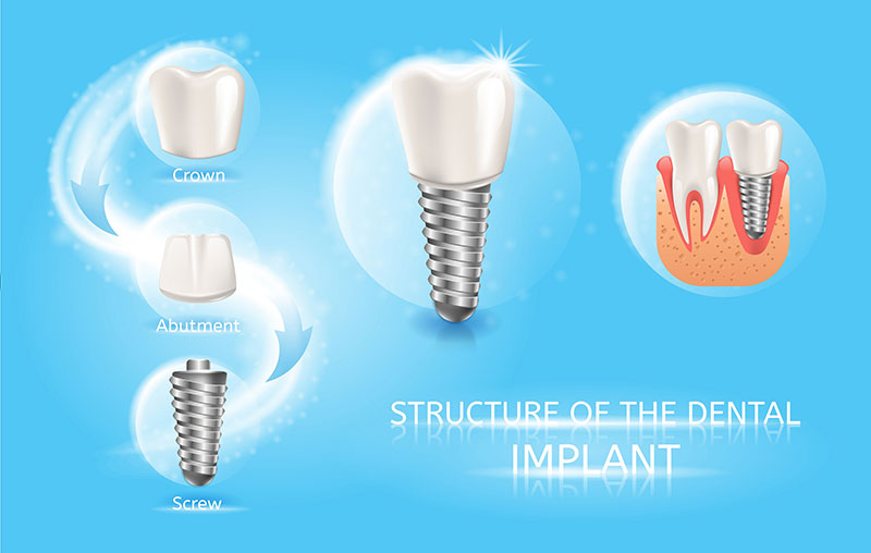 Tooth Implant Structure - Melissa, TX Dentist | Paradise Dental