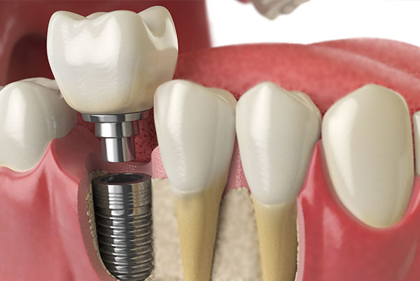 Dental Implants - Melissa, TX Dentist