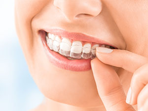 Invisalign Dentist - Melissa, TX